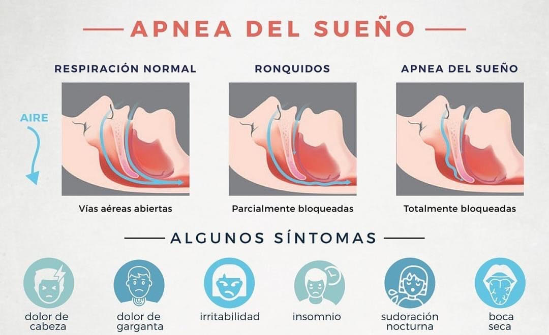 Qué es la Apnea de Sueño ?